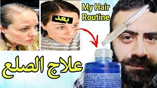 روتيني الخاص لعلاج الصلع الوراثي  لماذا لا استخدم المينوكسيديل 5 و نيو هير لوشن  Hair Care Routine [upl. by Northway928]