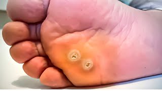 How To Remove a Foot Corn or Callus Foot Doctor Home Treatment [upl. by Nico340]