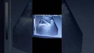 Adnexal Cyst on Ultrasound  Gyne Scan [upl. by Zaremski695]