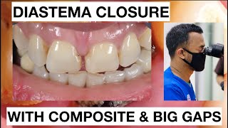 Step by Step Diastema Closure Composite with Big Gaps  General Dentist Griya RR [upl. by Eiboj]