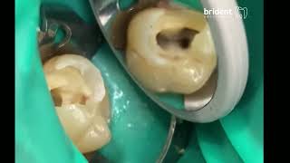 🦷Endodoncia Tenerife Paso a Paso Brident Odontologos Canarias🦷👉Clínicas Dentales Tenerife [upl. by Ariem]