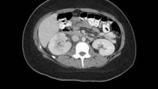 Radiology Rounds  A Radiologist Auntminnie CT scan of pyelonephritis [upl. by Fitalludba]