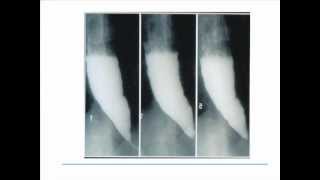 Esophageal Motility Disorders [upl. by Raffarty]