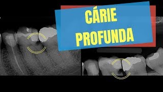 3 PASSOS PARA SABER SE UMA CÁRIE PROFUNDA VAI DAR ENDO  QUICK TIP ENDOLOVERS [upl. by Alikam]