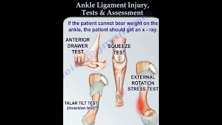 Ankle Ligament Injury evaluation and tests  Ankle ligament injury diagnosis and treatment [upl. by Schumer308]