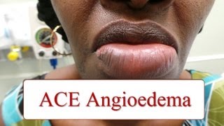 ACE Inhibitor Associated Angioedema [upl. by Eenel]