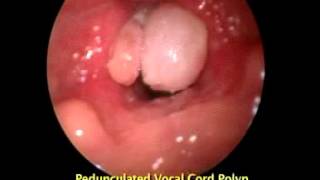 Pedunculated Vocal Cord Polyp Polyp [upl. by Lednew]