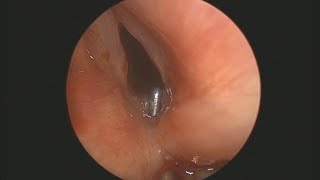 Example of Dynamic 3Phase Rigid Laryngotracheobronchoscopy [upl. by Ardnohs]