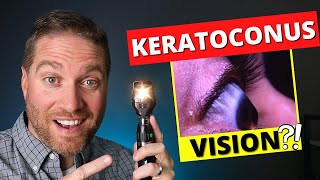 What Is Vision Like With Keratoconus And Irregular Astigmatism [upl. by Longerich]