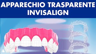 APPARECHIO trasparente con allineatori dentali invisibile  INVISALIGN © [upl. by Alam86]