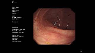 Ulcerative Colitis and small polyp Asacol  OLYMPUS 290  CFH260AL NINJA V Recording 20240819 [upl. by Myrlene409]