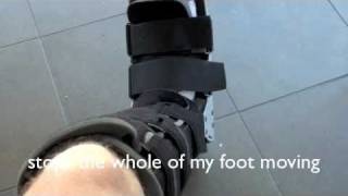 Stress Fracture 2nd Metatarsal [upl. by Aerdnuahs]