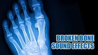 Bone Breaking Sound Effect 🦴 Bone Snapping Sounds [upl. by Ridgley90]