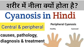 what is cyanosis  causes types amp treatment in Hindi [upl. by Ynetsed]