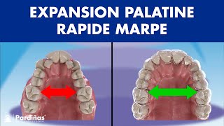 Expansion palatine rapide MARPE  DISJONCTEUR ORTHODONTIQUE chez ladulte © [upl. by Krystal]