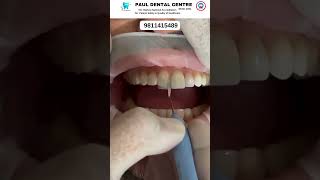 Composite Veneers Your Path to a Brighter Smile dentalcare smilemakeover dentalhealth [upl. by Ruthven]