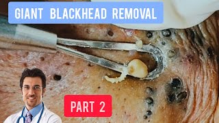 Massive blackhead removal inside a dermatology clinic  DrAMAZINGSKIN [upl. by Ellata]