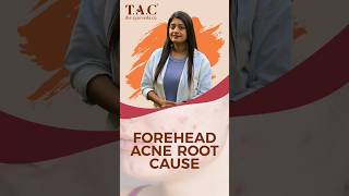 Reasons for Forehead Acne  Acne [upl. by Surtimed]