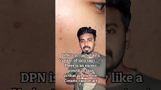 DPN removal from Face  Is it harmful Skin tag  மரு  Dr Thamizhinian  Dermatologist skintags [upl. by Cathrine832]