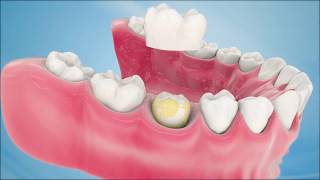 Dental Implant Procedure A Step by Step Guide [upl. by Bancroft588]