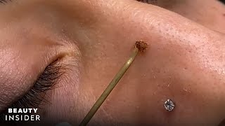 HOW TO REMOVE SKIN TAGS AT HOME FAST  Does Claritag Work My Honest Review [upl. by Sholem185]