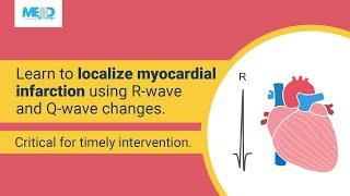 How to localize myocardial infarction based on RWave shrinkage and Qwave development [upl. by Senior]