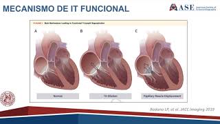 Regurgitação Tricúspide Funcional Mecanismo e o Papel da Imagem [upl. by Farrel]