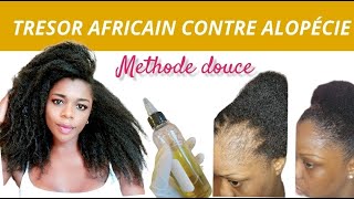 La vraie Solution contre lalopécie pour retrouver ses cheveux rapidement [upl. by Neirual]