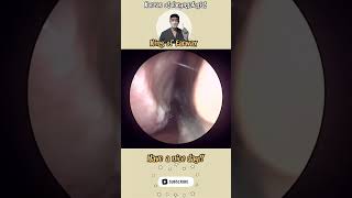 rhinorrhea sinusitis bersihkankuping satisfyingvideos pembersihan telinga video puas hati [upl. by Dorree622]