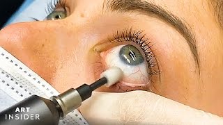 Eyelid Microexfoliation Cleanses Your Eyes [upl. by Arrak]