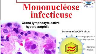 Infection à cytomégalovirus CMV Mononucléose infectieuse [upl. by Dunham102]