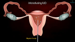 Intrauterine Device IUD Copper T Removal procedure  Patient Education Medical animation [upl. by Kenna]