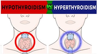 Hyperthyroidism Vs Hypothyroidism ll endocrinesystem [upl. by Liva]