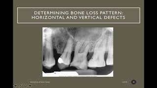 Interpretation of Periodontal Disease Source [upl. by Nossila]