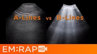 Ultrasound of Pulmonary Edema [upl. by Tirrell]