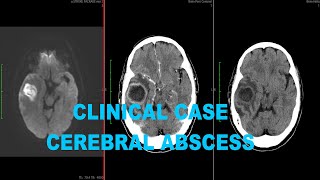 Clinical Case Cerebral abscess on CT and MRI [upl. by Deeraf]