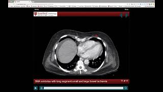 NEW Radiology of the Acute Abdomen [upl. by Nedrah170]