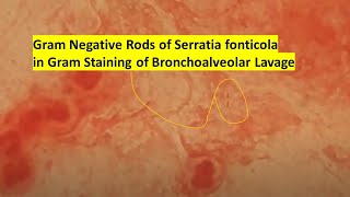 Gram Negative Rods of Serratia fonticola in Gram Staining of Bronchoalveolar Lavage [upl. by Garin707]