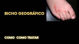 Bicho geográfico como tratar [upl. by Sergent]