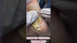 Corn or Verruca treatment shortvideo doctor shortsviral shorts [upl. by Wesle]