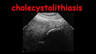 cholecystolithiasis [upl. by Odessa]