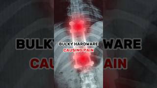 Spinal Fusion Hardware Removal Explained [upl. by Orodoet]