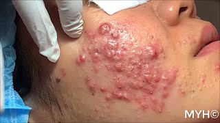 Cystic Pustules Acne Extractions EP14 No Clickbait [upl. by Annabelle]