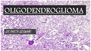 Oligodendroglioma [upl. by Elitnahc]