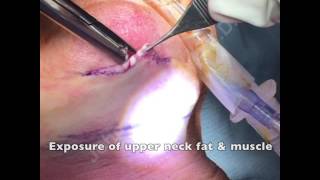 Double Chin Correction aka quotPlatysmaplastyquot [upl. by Elata]