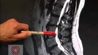 Low Back Pain Part 8 Spinal Stenosis [upl. by Melloney]