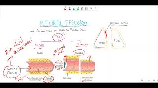 Pleural effusionTransudate vs exudate Light criteria [upl. by Lapointe]