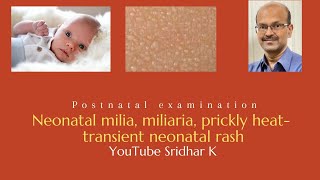 Neonatal milia miliaria and prickly heat Dr Sridhar K [upl. by Roosnam]