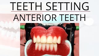 Teeth Setting Anterior Teeth [upl. by Hanshaw471]