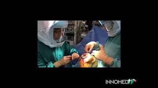 Innomed Whang Tibial Osteotome [upl. by Rakso]